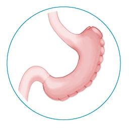A stomach resized using gastric plication surgery.